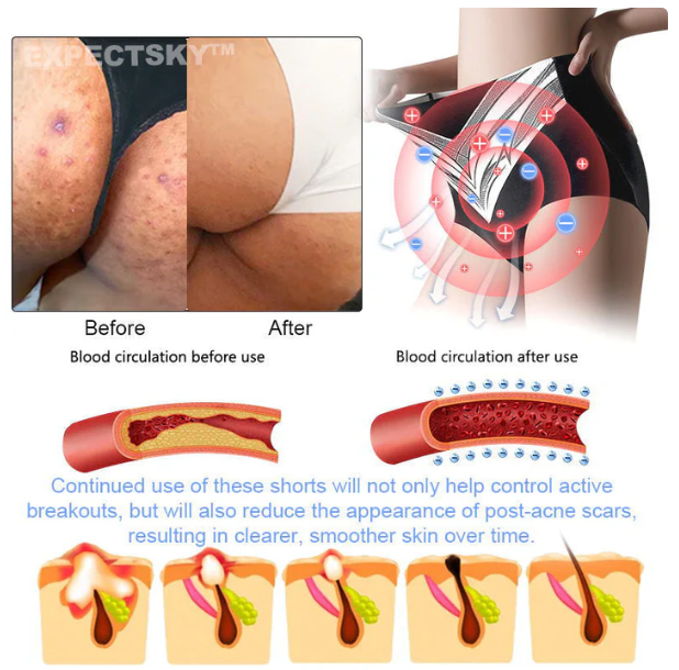 Orvosi minőségű titánszálas önmelegedő turmalin formájú rövidnadrág