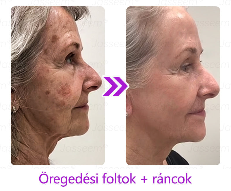 𝐉𝐚𝐬𝐬𝐞𝐞𝐦® Fejlett, nem invazív bőrjavító CO₂ lézeres toll 🎉 (Gyengéden eltávolítja a szemölcsöket, anyajegyeket, öregségi foltokat és bőrkinövéseket – fájdalom és gond nélkül!)