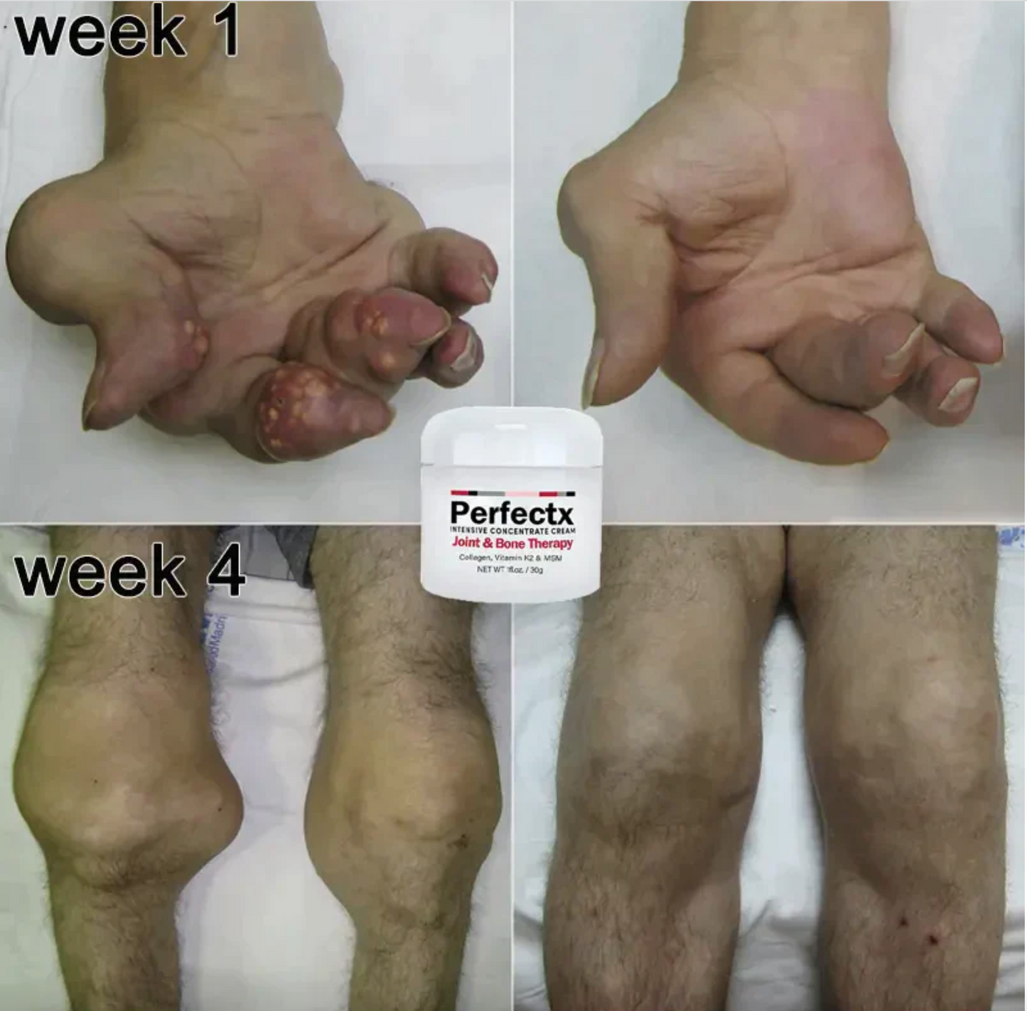 GFOUK™ PERFECTX ÍZÜLETI ÉS CSONTGYÓGYÍTÓ KRÉM